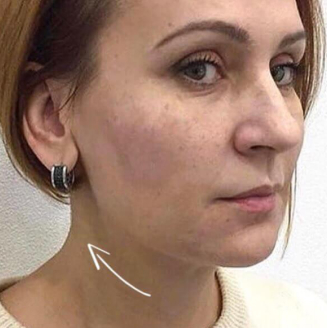 Результат після процедури
